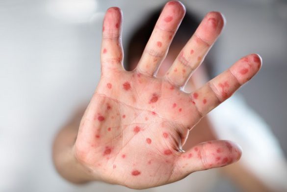 Viral Diseases – Hand Infected – Hand foot and mouth disease HFMD
