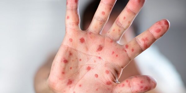 Viral Diseases – Hand Infected – Hand foot and mouth disease HFMD