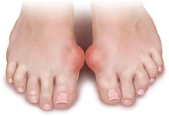 bệnh Gout nổi ám ảnh kinh hoàng 1