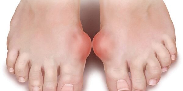 bệnh Gout nổi ám ảnh kinh hoàng 1